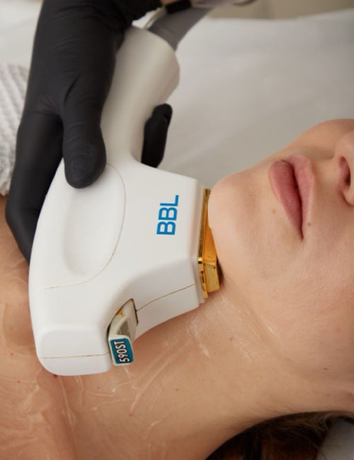 Kırmızı Yüz Tedavisi - BBL Lazer