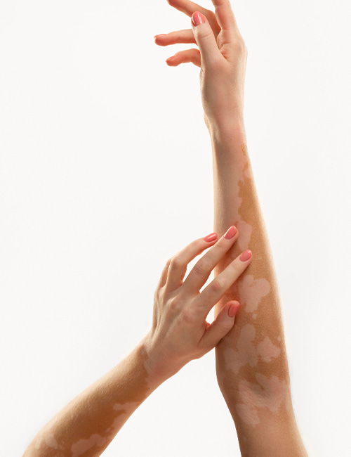 Psoriasis Ve Vitiligo Tedavisi